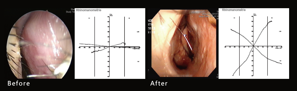 ▲透過手術前後鼻阻力圖對照，術前左右兩側鼻阻力線都接近水平線，表示呼吸阻力極大，術後鼻阻力線恢復正常曲線，接近兩邊對稱，表示呼吸恢復暢通，傷口也恢復良好。