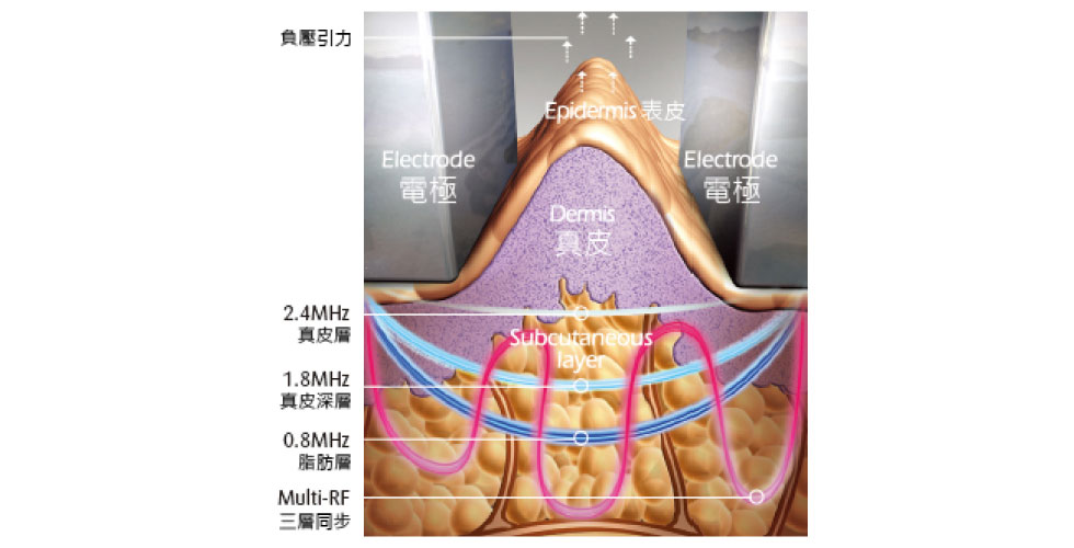 三層電波頻率同步，分別針對淺、中、深層的皮膚進行作用，選擇性加熱不 同的皮膚組織層，S其中淺、中層電波可刺激皮下膠原蛋白增生，達到緊實、拉提的效果；深層電波則可強化代謝與循環，減少脂肪細胞的體積。