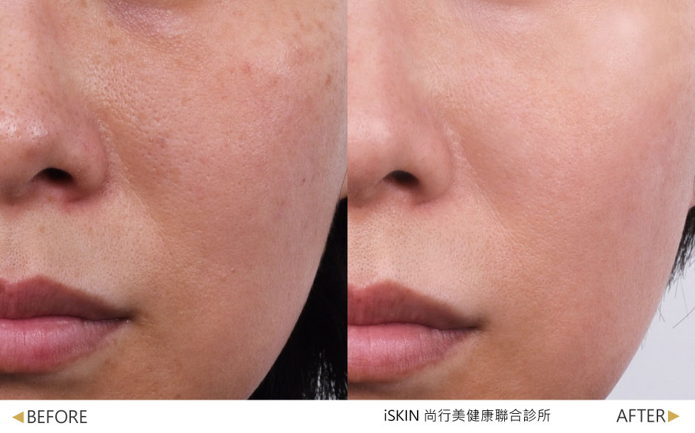 麗珠蘭REJURAN® SKIN BOOSTER效果-術後約2週效果，蜂巢皮秒+麗珠蘭白瓷水光—使用蜂巢皮秒淡化斑點搭配麗珠蘭白瓷水光，提亮膚色使肌膚更加透亮，實際效果因個案而異。