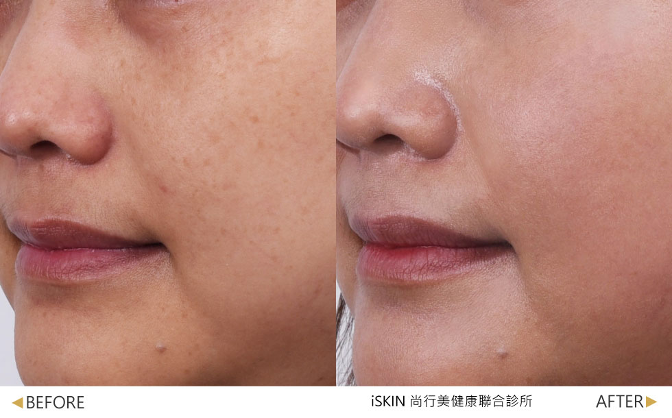 麗珠蘭REJURAN® SKIN BOOSTER效果-術後約2週效果，蜂巢皮秒+麗珠蘭白瓷水光—使用蜂巢皮秒淡化斑點搭配麗珠蘭白瓷水光，提亮膚色使肌膚更加透亮，實際效果因個案而異。