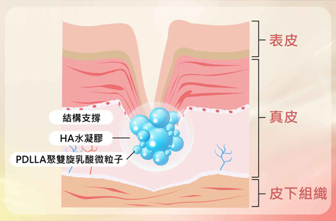 注射後，會在注射部位起到支撐作用。