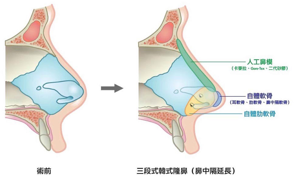 三段式結構式隆鼻剖析圖。