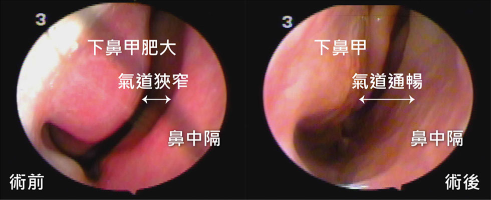 內視鏡可看出術前(左)鼻中隔彎曲、下鼻甲肥大，導致睡眠呼吸不順、有打呼的情況，術後(右)經過廣達光纖雷射下鼻甲微創術，下鼻甲均勻縮小以及鼻中膈矯正，氣道變大、呼吸順暢。